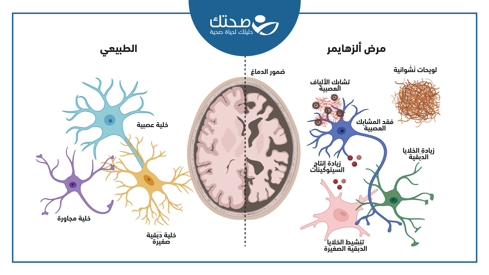 ألزهايمر