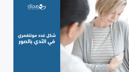 درنات مونتغمري أو بثور حلمات الثدي