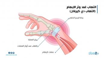  التهاب مفصل الإبهام