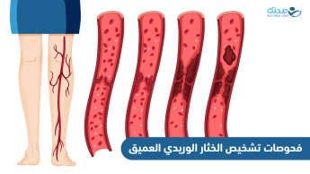 فحوصات تشخيص الخثار الوريدي العميق