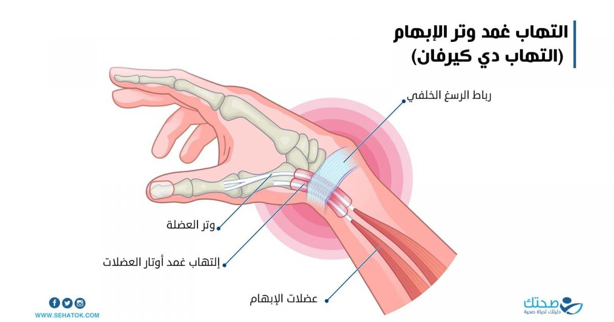 أسباب وعلاج ألم إصبع الإبهام: كل ما تحتاج إلى معرفته