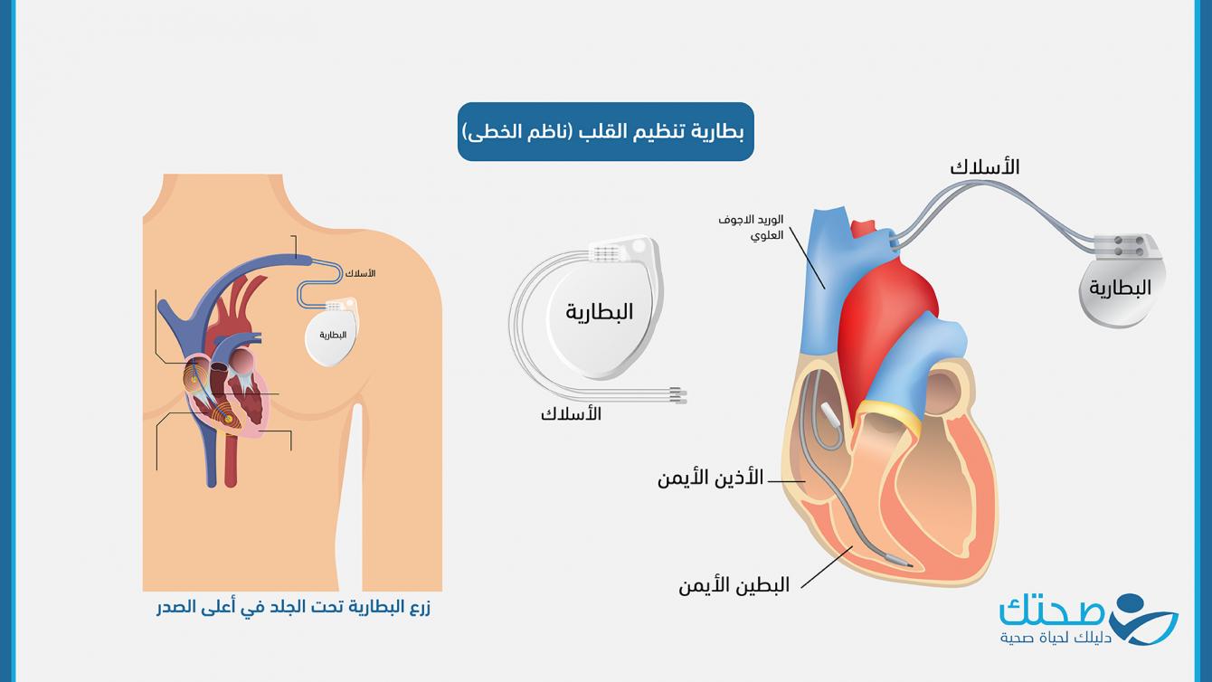 بطارية تنظيم القلب (ناظم الخطى)