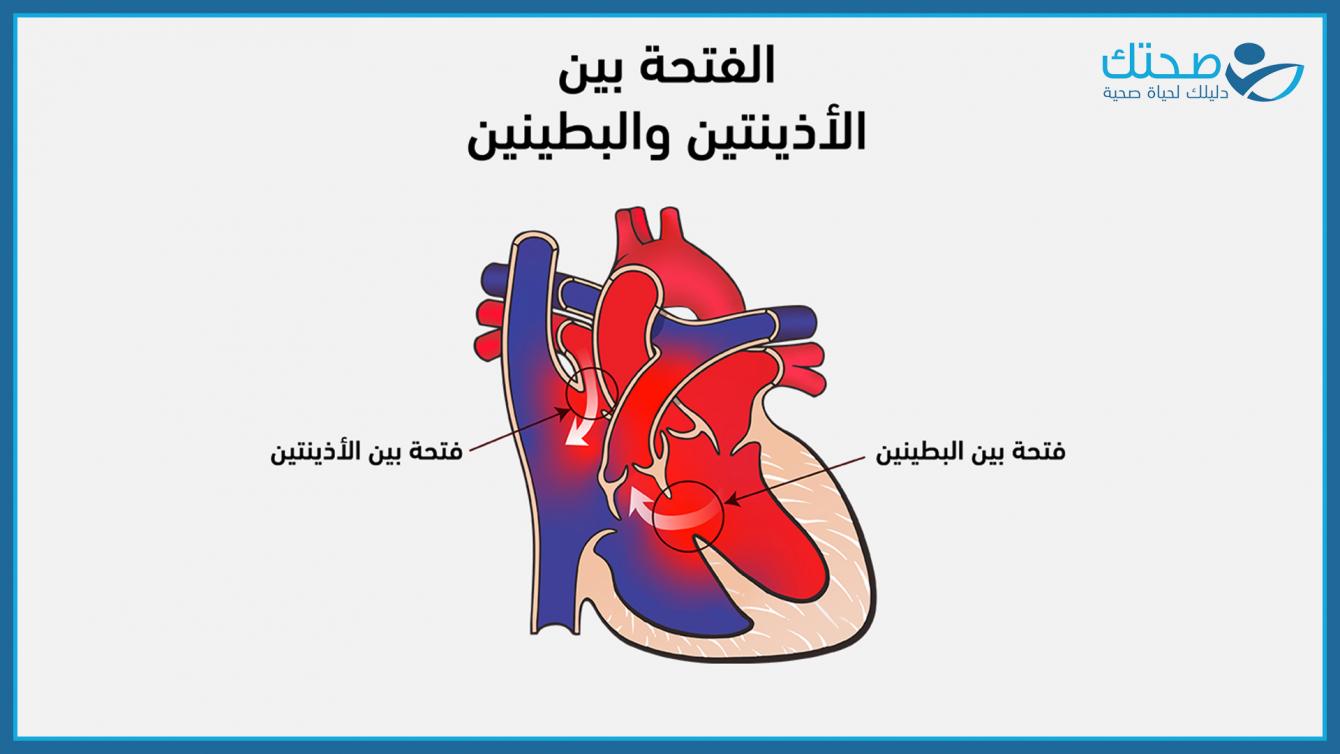 الفتحة بين الأذينتين والبطينين