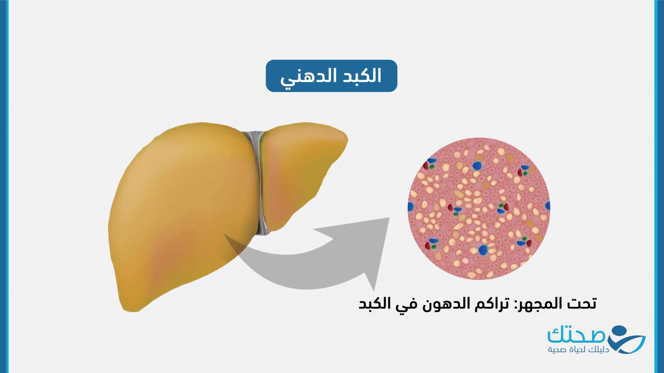 الكبد الدهني