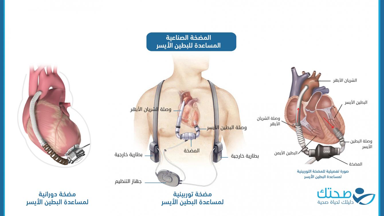  المضخة الصناعية المساعدة للبطين الأيسر