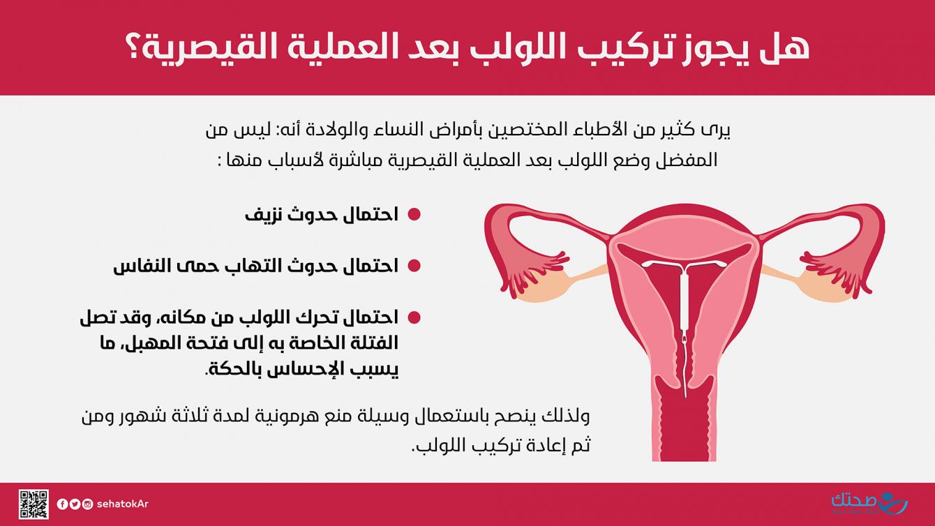 تركيب اللولب بعد الولادة القيصرية