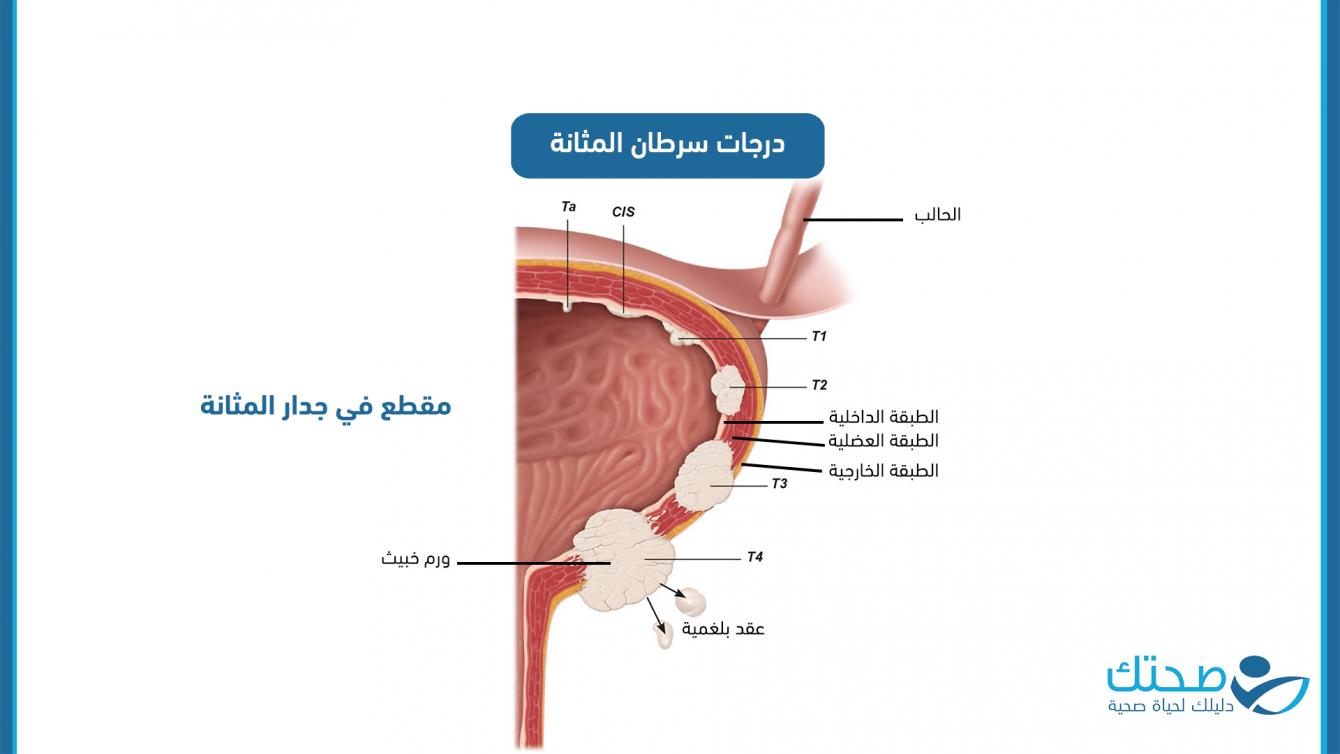 درجات سرطان المثانة