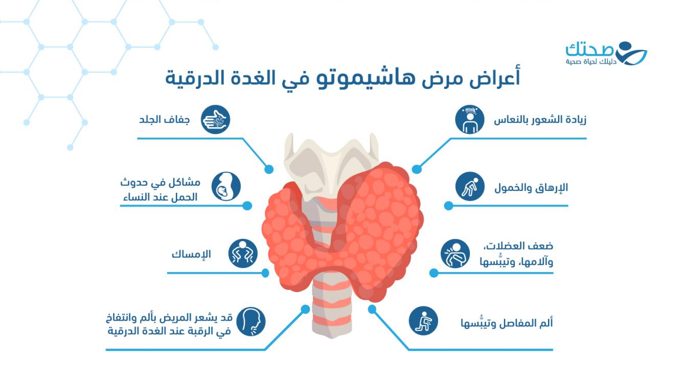 مرض هاشيموتو في الغدة الدرقية.