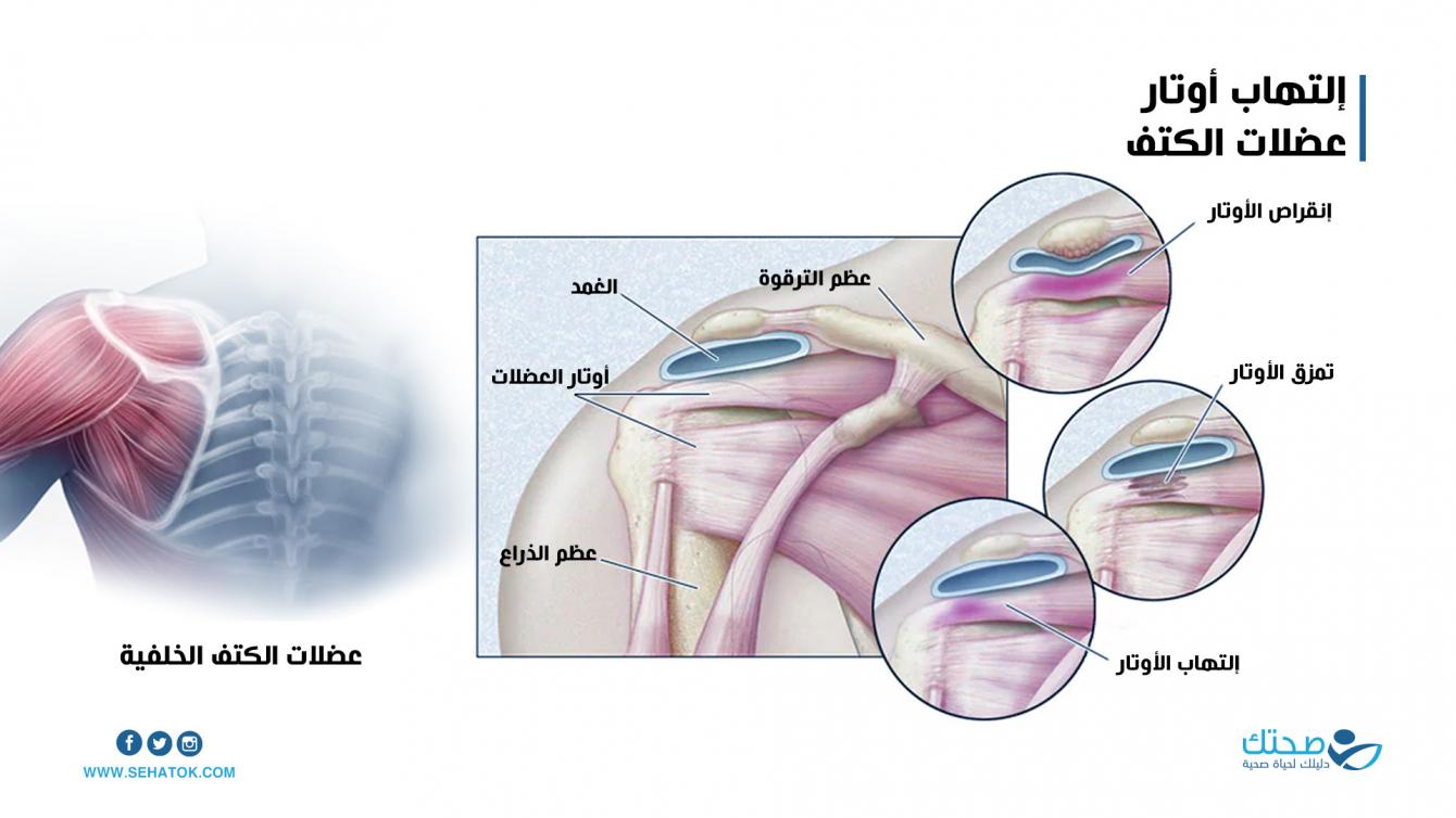 التهاب أوتار عضلات الكتف