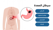 سرطان المعدة